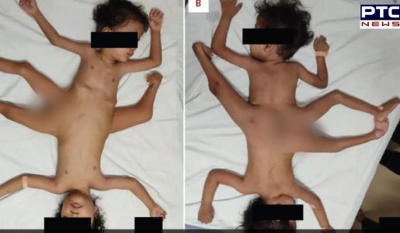 Exceptionally rare conjoined twins born in Indonesia possess four arms and three legs