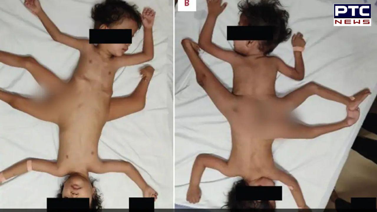 Exceptionally rare conjoined twins born in Indonesia possess four arms and three legs