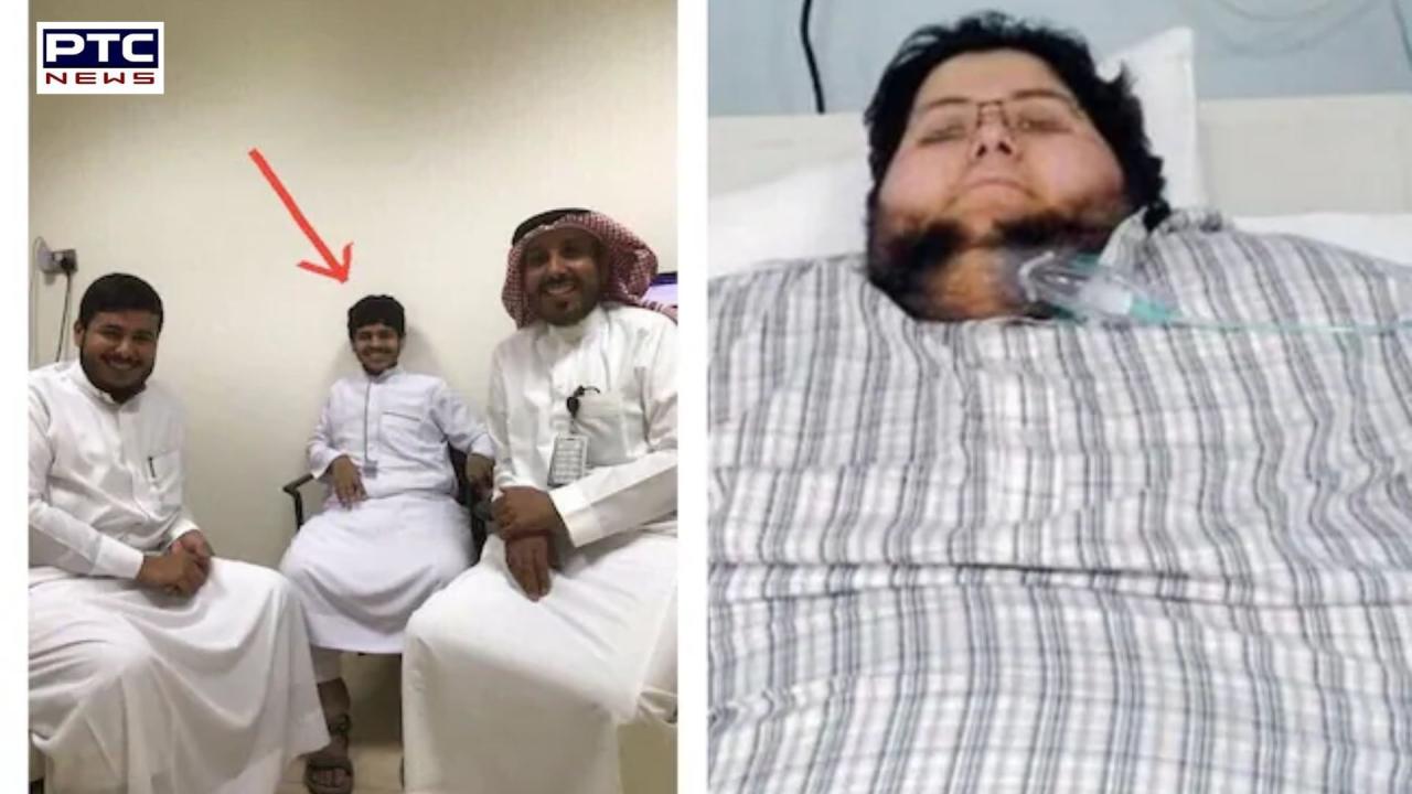 Saudi man loses over 500 kilos with help from former King