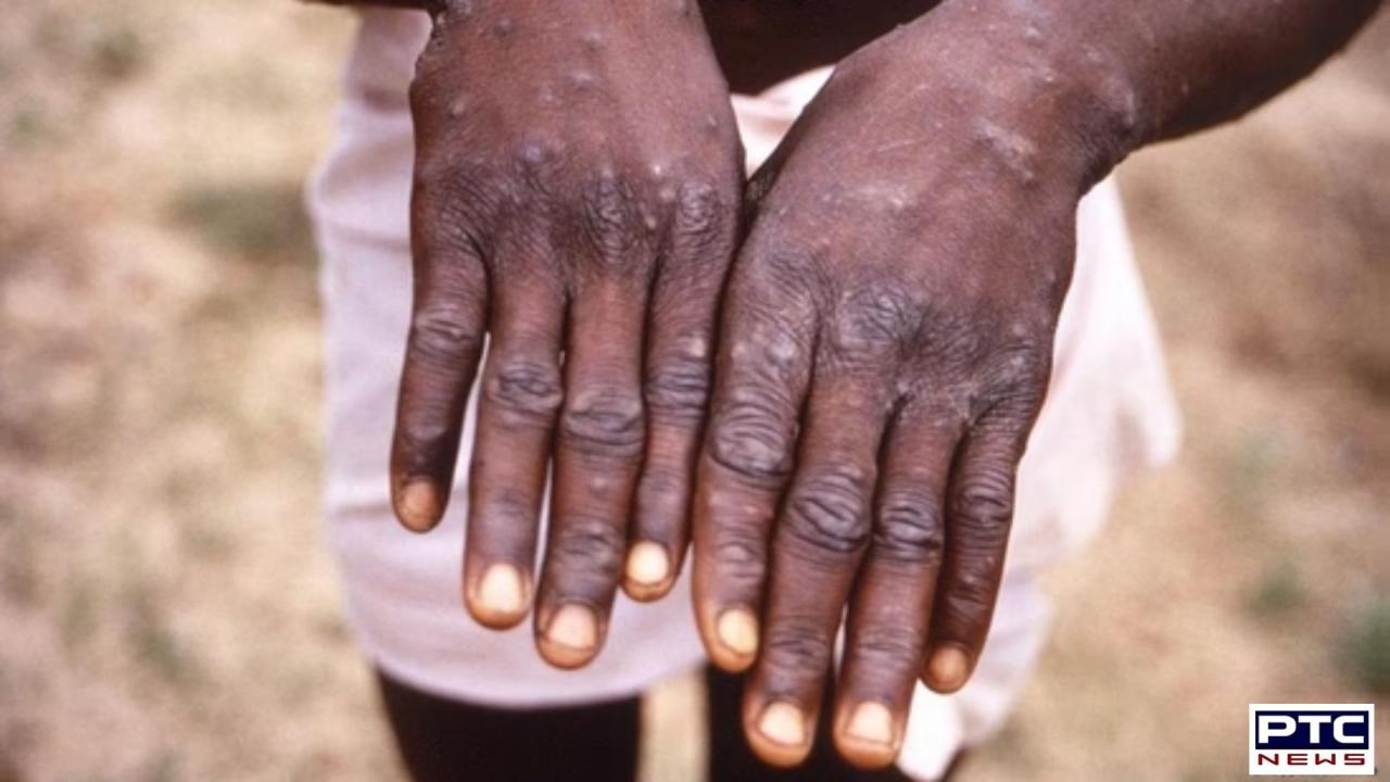 Mpox outbreak: WHO declares global health emergency: Symptoms, prevention, and reasons behind the alert—explained