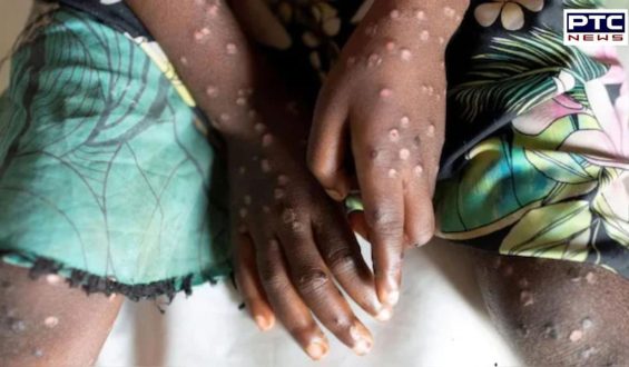 Mpox cases in Africa surge to over 18,700 as new deadly clade 1b strain spreads