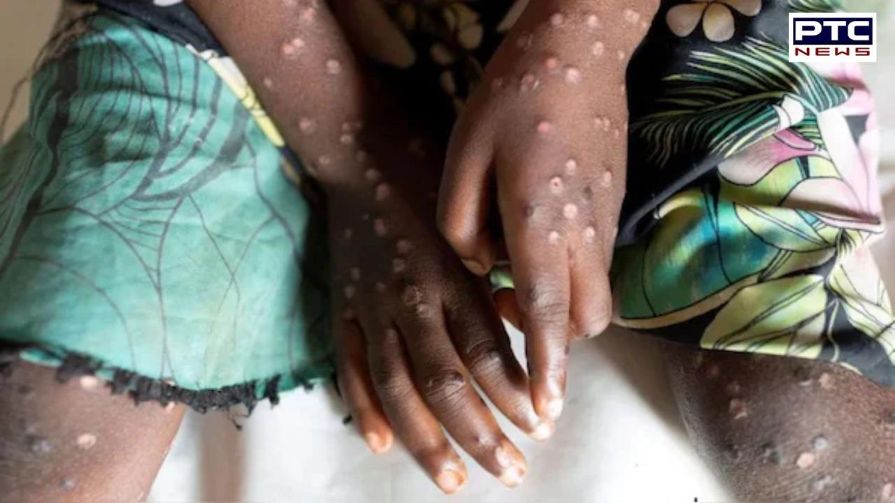 Mpox cases in Africa surge to over 18,700 as new deadly clade 1b strain spreads